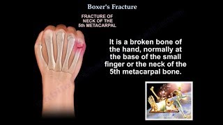 Boxers Fracture  Everything You Need To Know  Dr Nabil Ebraheim [upl. by Nah221]