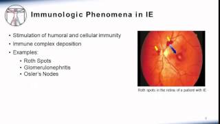 Endocarditis Clinical Manifestation [upl. by Levinson]