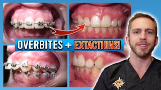 Braces Overbite Treatment BEFORE amp AFTER [upl. by Ev]