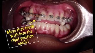 Anterior Crossbite Fix with Braces [upl. by Lesab]