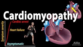 Cardiomyopathy animation [upl. by Ansilma]