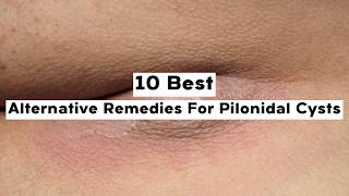 10 Alternative Remedies For Pilonidal Cysts [upl. by Egamlat352]