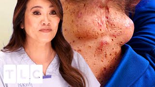 CYSTception A Cyst INSIDE A Cyst SQUIRTALERT  Dr Pimple Popper [upl. by Ellevehc]