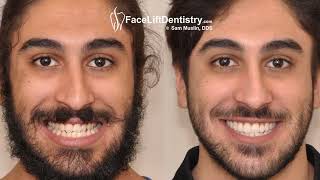 Underbite Crooked Teeth Crossbite Correction with VENLAY® Bite Restoration [upl. by Rentsch602]